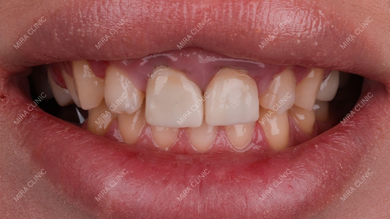 Gums before treatment
